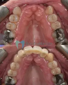 dental implant before and after